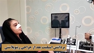 برداشتن اسپلینت بعد از جراحی رینو‌پلاستی | دکتر بیاضیان
