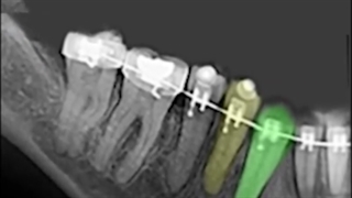 ارتودنسی دندان نهفته | دکتر داودیان