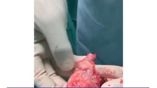 عارضه سیاه شدن سر استخوان ران به دلیل مصرف داروی چاقی | دکتر قرنی زاده