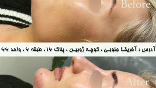 تزریق ژل چانه