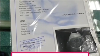 بارداری حاصل ivfدر خانمی با تخمدان پلی کیستیک و ۱۳ سال ناباروری