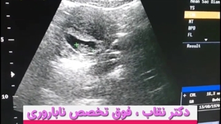 بارداری موفق در خانمی با روش ivf و بیماری لوپوس