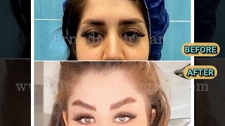 نمونه جراحی های لیفت اندوسکوپیک ابرو