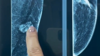 تصورات غلط در مورد سرطان پستان