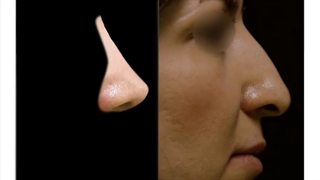 نتیجه جراحی بینی بعد از 2 ماه