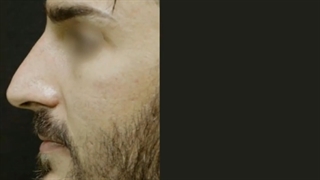 2 ماه بعد از جراحی زیبایی بینی