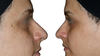 5 سال بعد از جراحی بینی زیباجوی عزیزما