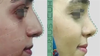 8 ماه بعد از جراحی بینی زیباجوی عزیز