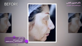 فیلم جراحی زیبایی بینی