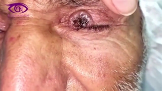 برداشتن توده سرطانی از پلک فوقانی