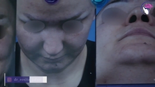 جراحی زیبایی بینی با انحراف