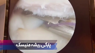 جراحی پارگی منیسک