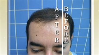 کاشت مو آقایان