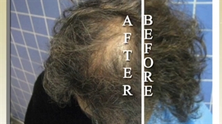 کاشت موی طبیعی برای مراجعه کننده