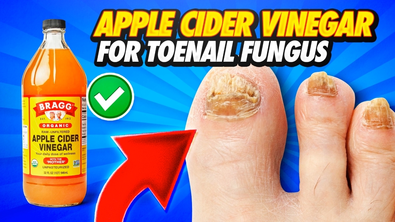 Does apple cider vinegar get rid of fingernail fungus