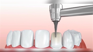 فیلم تراش دندان برای لمینت