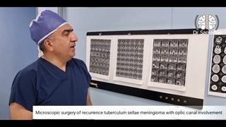 عمل جراحی میکروسکوپی عود مننژیوم توبرکلوم سلا با درگیری کانال بینایی