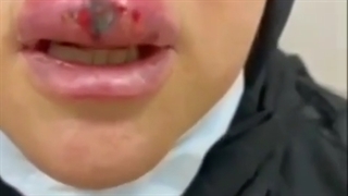 عوارض تزریق ژل لب توسط آرایشگر