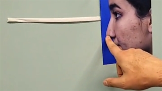 جراحی بینی با غضروف دنده