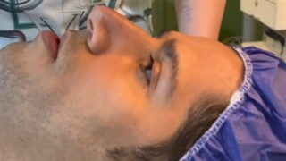 عمل جراحی بینی طبیعی و مردانه