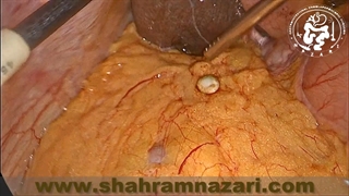 سنگ داخل شکم