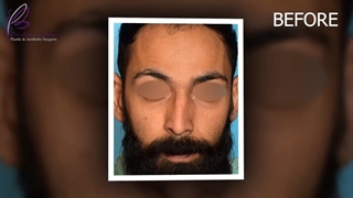 جراحی زیبایی بینی در آقایان