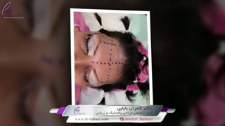 لیفت پیشانی با آندوسکوپ