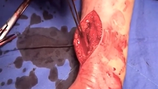 خارج سازی تومور دست نوجوان 14 ساله