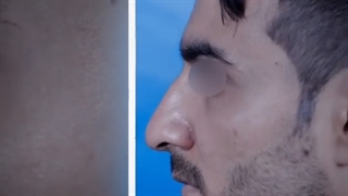 رینوپلاستی در آقایان