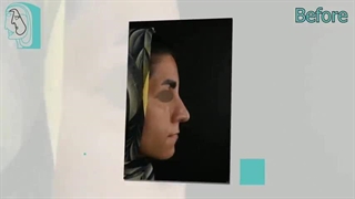 تا چند وقت بعد از جراحی بینی نمی توان عینک زد؟