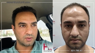 تجربیات واقعی کاشت مو مراجعه کننده کلینیک هلیا