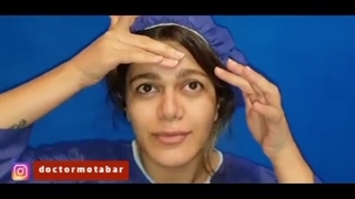 لیفت ابرو و شقیقه، آندوسکوپی