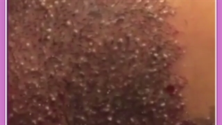 قدم به قدم با کاشت موی طبیعی | نتیجه نهایی کاشت مو چه زمانی است؟