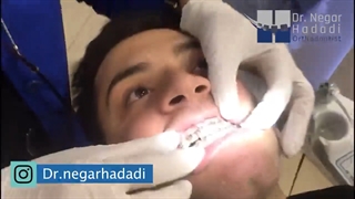 درمان ارتوسرجری در ارتودنسی | دکتر نگار حدادی