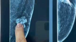 سرطان پستان و شایعه هایش