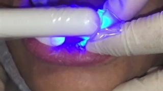 لامینیتهای سرامیکی ips