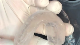 مراحل تحویل نایت گارد سخت به بیمار دارای عادات دهانی در شب ها