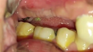 طرح درمان ایمپلنت در مواردی که فضای بین فکی خیلی کم است