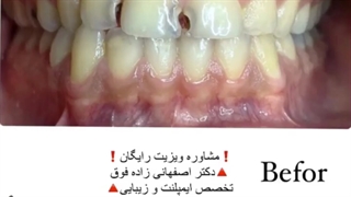 ترمیم پوسیدگی بین دندان ها