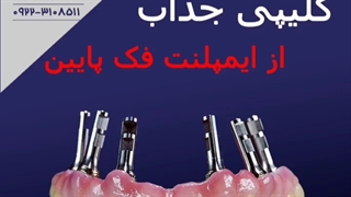 کلیپ جذاب از ایمپلنت فک پایین