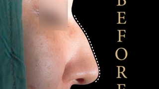 فیلم جراحی بینی استخوانی توسط دکتر بیاضیان