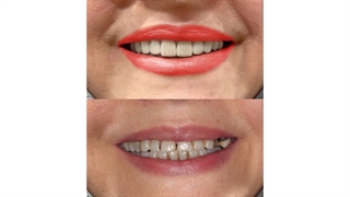 لمینت دندان بالا | لمینت بهترین درمان زیبایی برای داشتن لبخندی زیبا | سیمادنت