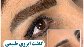 کاشت ابرو بعد از یکسال و نیم