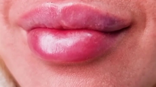 فیلر لب روسی
