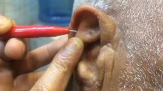 غده چربی یا لیپوم