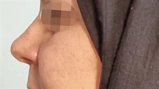 سه سال بعد از جراحی زیبایی بینی طبیعی
