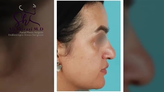 2سه هفته بعد از عمل بینی گوشتی