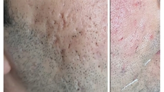 تزریق فیلر برای اسکار اکنه