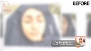 بینی غضروفی استخوانی با انحراف تیغه بینی و افتادگی نوک بینی