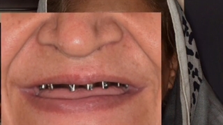 ایمپلنت فوری در کلینیک تخصصی ایمپلنت دکتر وحید دهقان